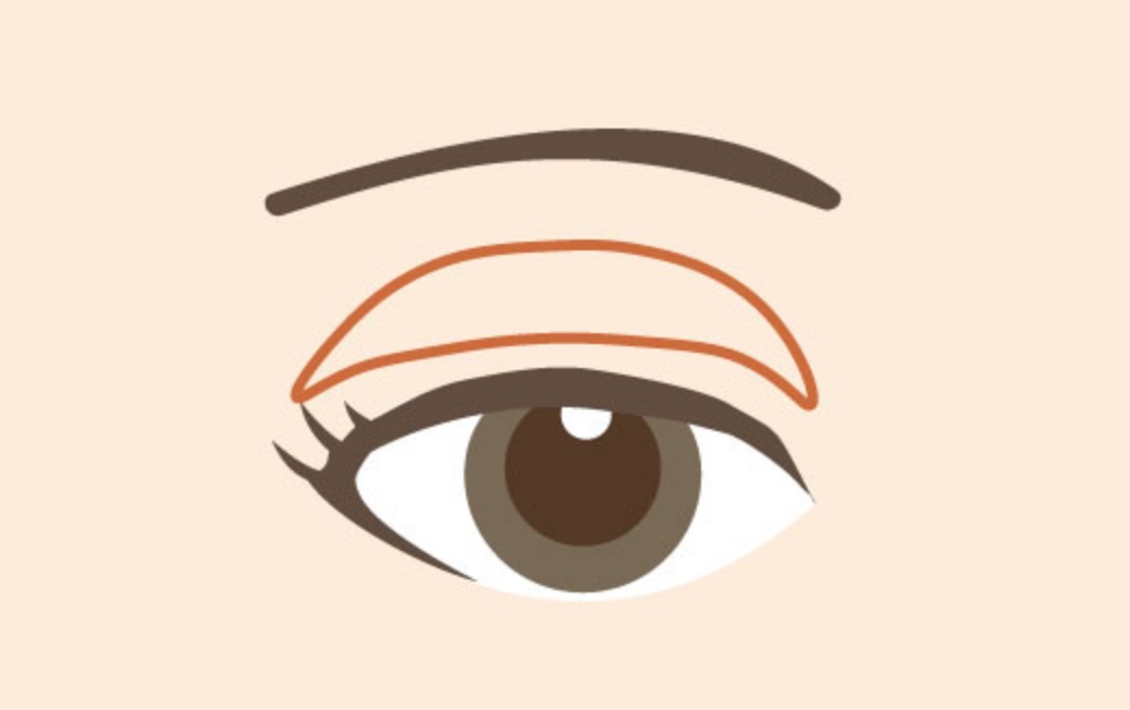 眼瞼下垂（眼瞼挙筋前転術）