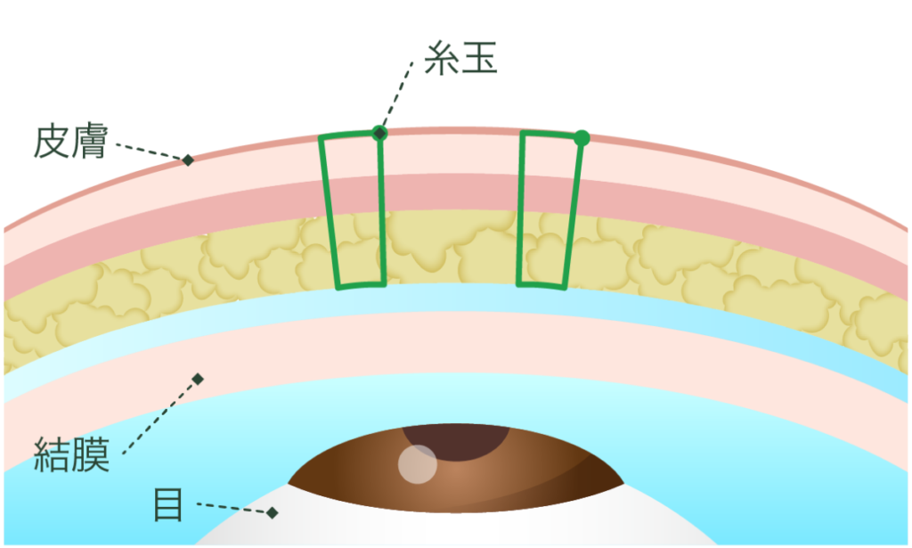 二重埋没法 スタンダード法