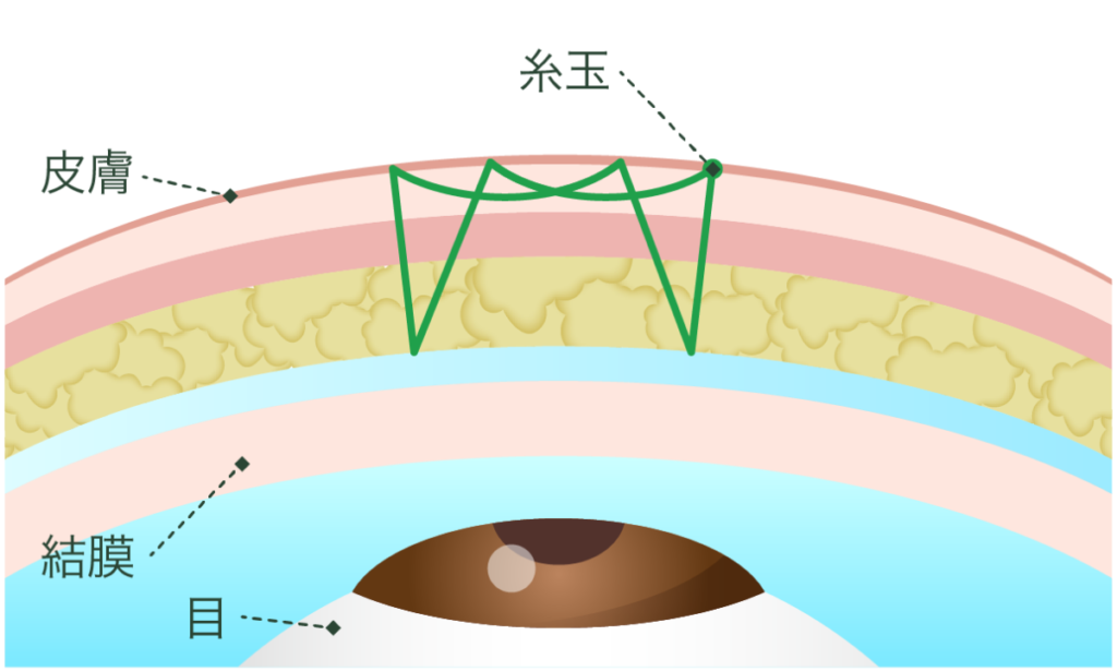二重埋没法 エタニティクロス法