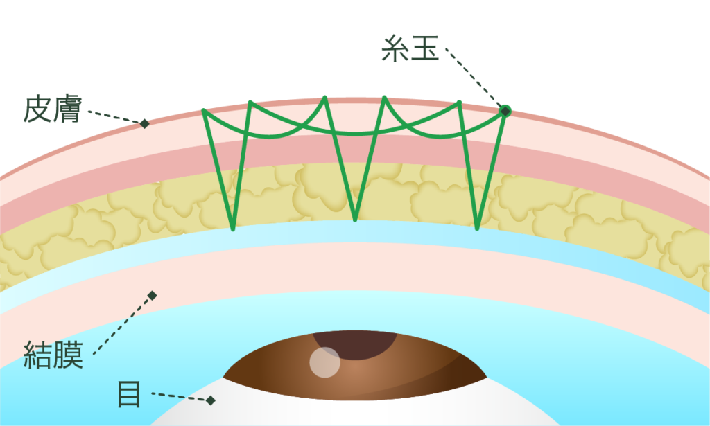 二重埋没法 エタニティクロス法パーフェクト