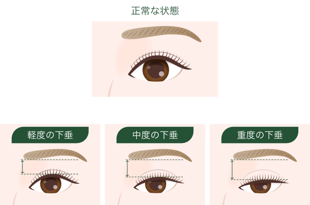眼瞼下垂の状態
