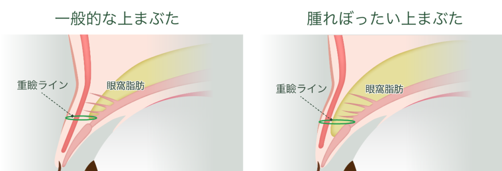 まぶたの脂肪の違い