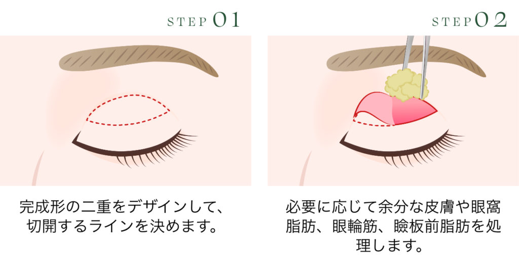 切開法手術イメージ