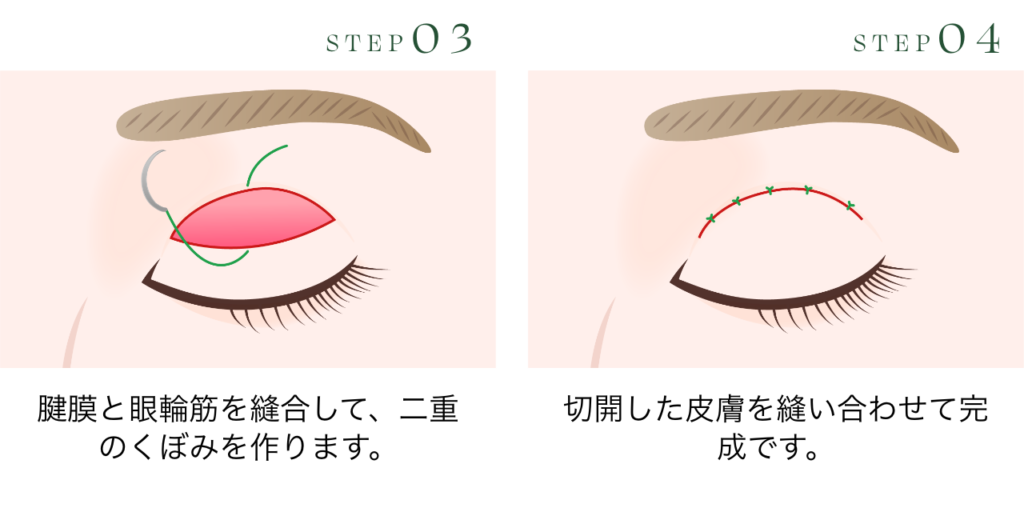 切開法手術イメージ