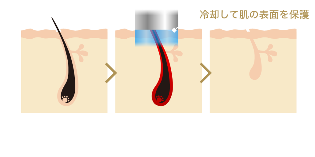 医療脱毛の仕組み