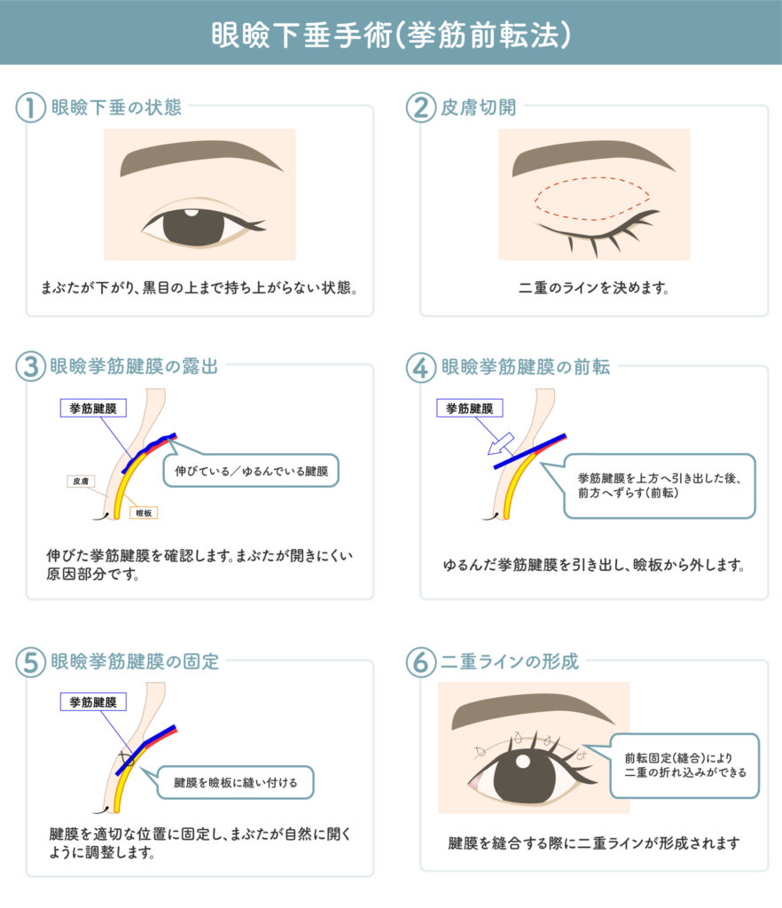 眼瞼下垂手術挙筋前転法