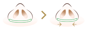 切らない小鼻縮小
