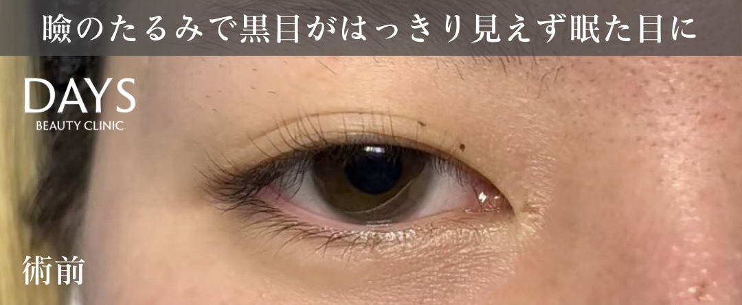 瞼のたるみで黒目がはっきり見えず眠た目に