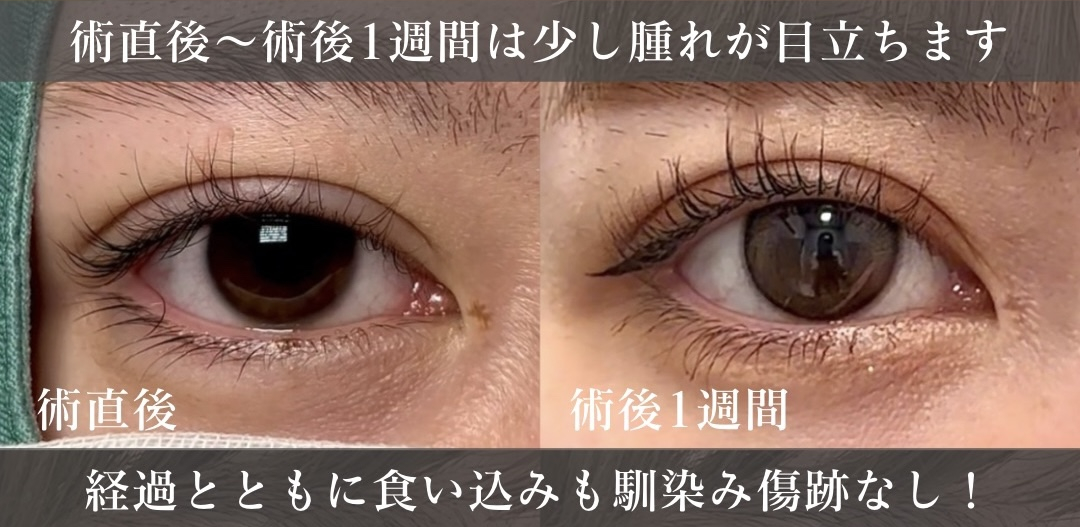 術直後～術後一週間は少し腫れが目立ちます。経過とともに食い込みも馴染み傷跡なし