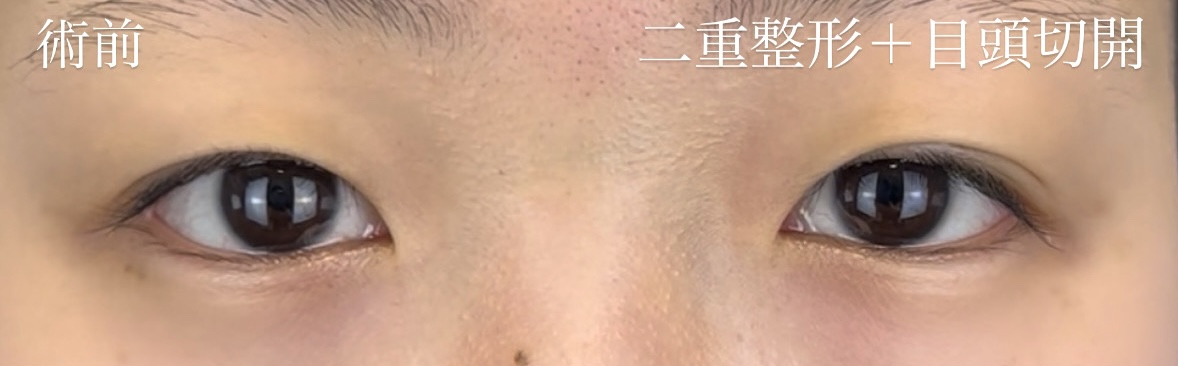術前　二重整形＋目頭切開