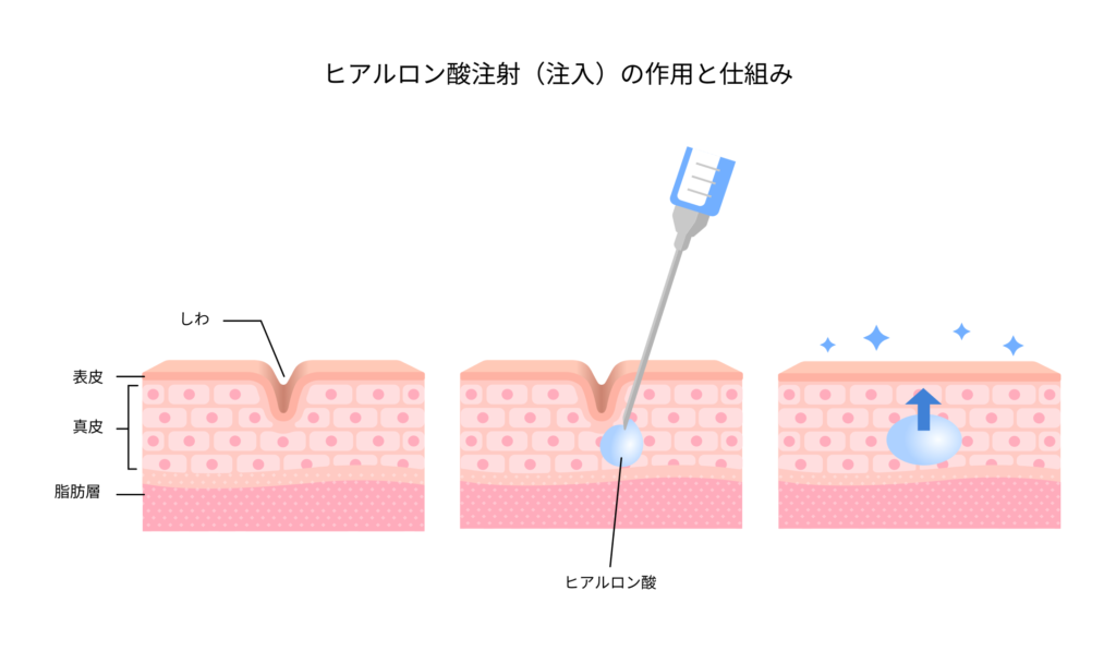新品「ヒアルロン酸注入治療 安全マニュアル 改訂第2版 必須の知識と事故対策」 ヒアルロン酸注入治療安全マニュアル | 克誠堂出版