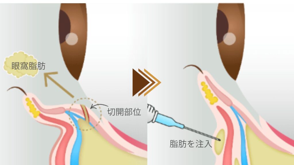 経結膜脱脂＋脂肪注入
