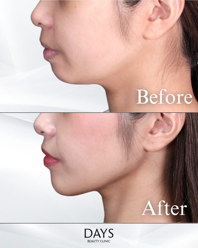 顎のヒアルロン酸　症例　20代女性