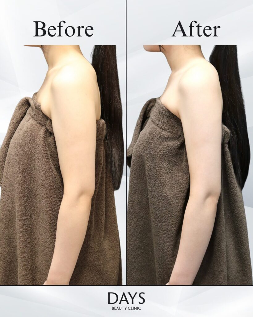 二の腕脂肪吸引　症例　20代女性