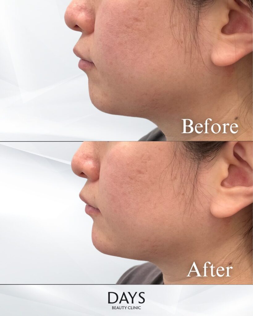 顎のヒアルロン酸　症例　20代女性