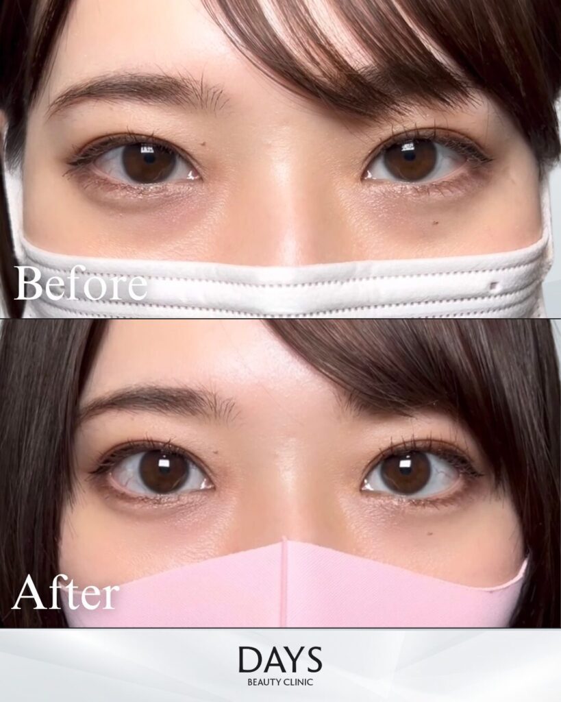 グラマラスライン形成　症例　30代女性