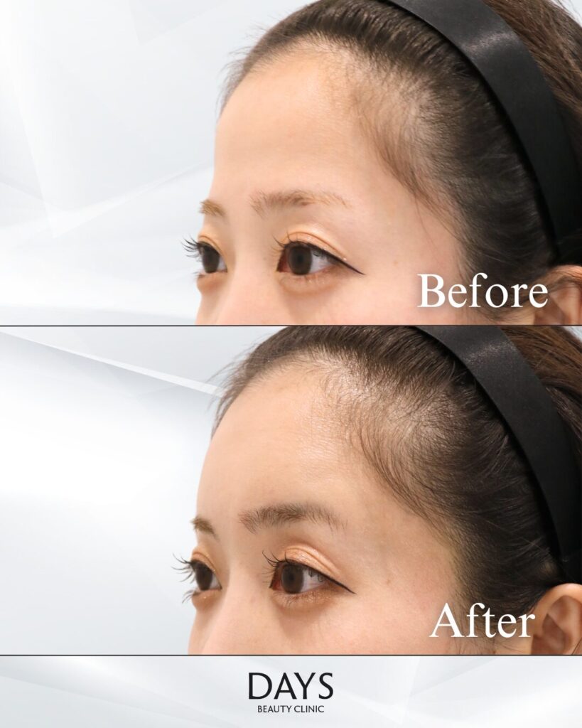 額のヒアルロン酸　症例　30代女性