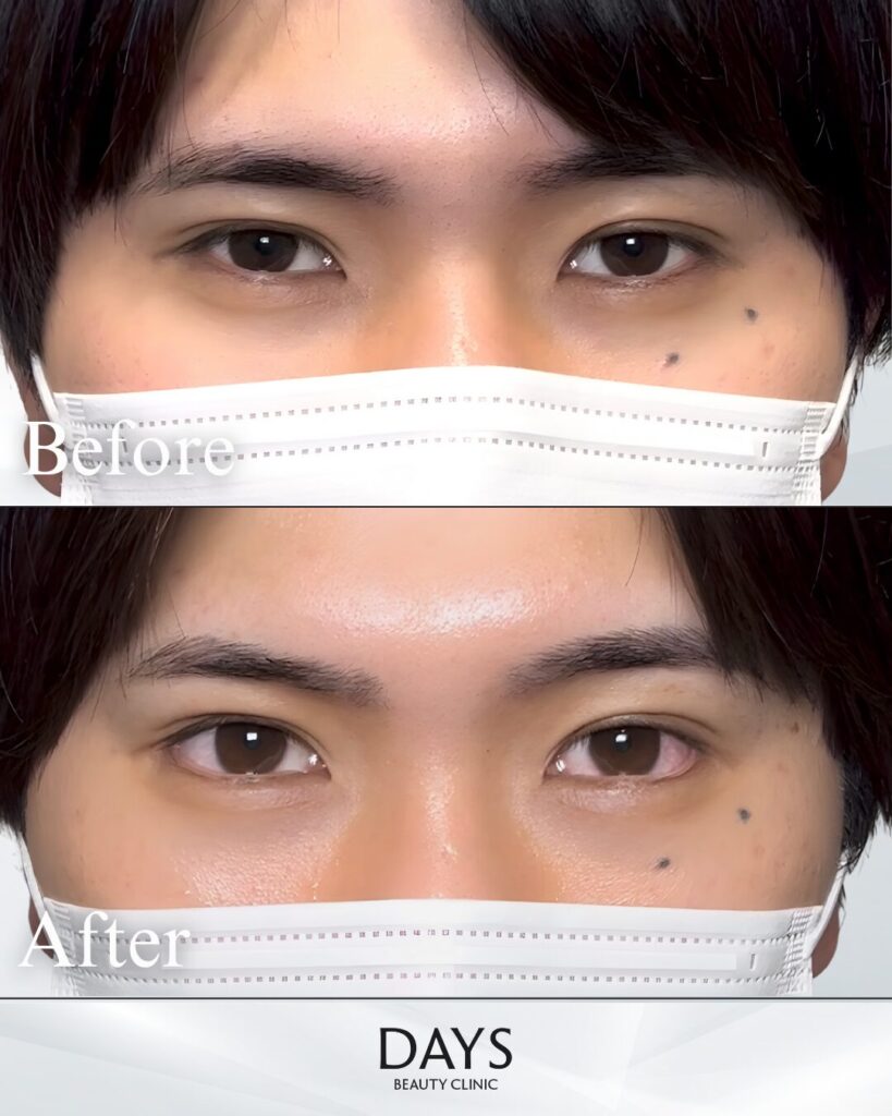 グラマラスライン形成　症例　20代男性