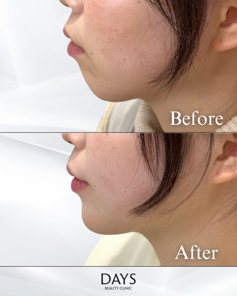 顎のヒアルロン酸　症例　20代女性