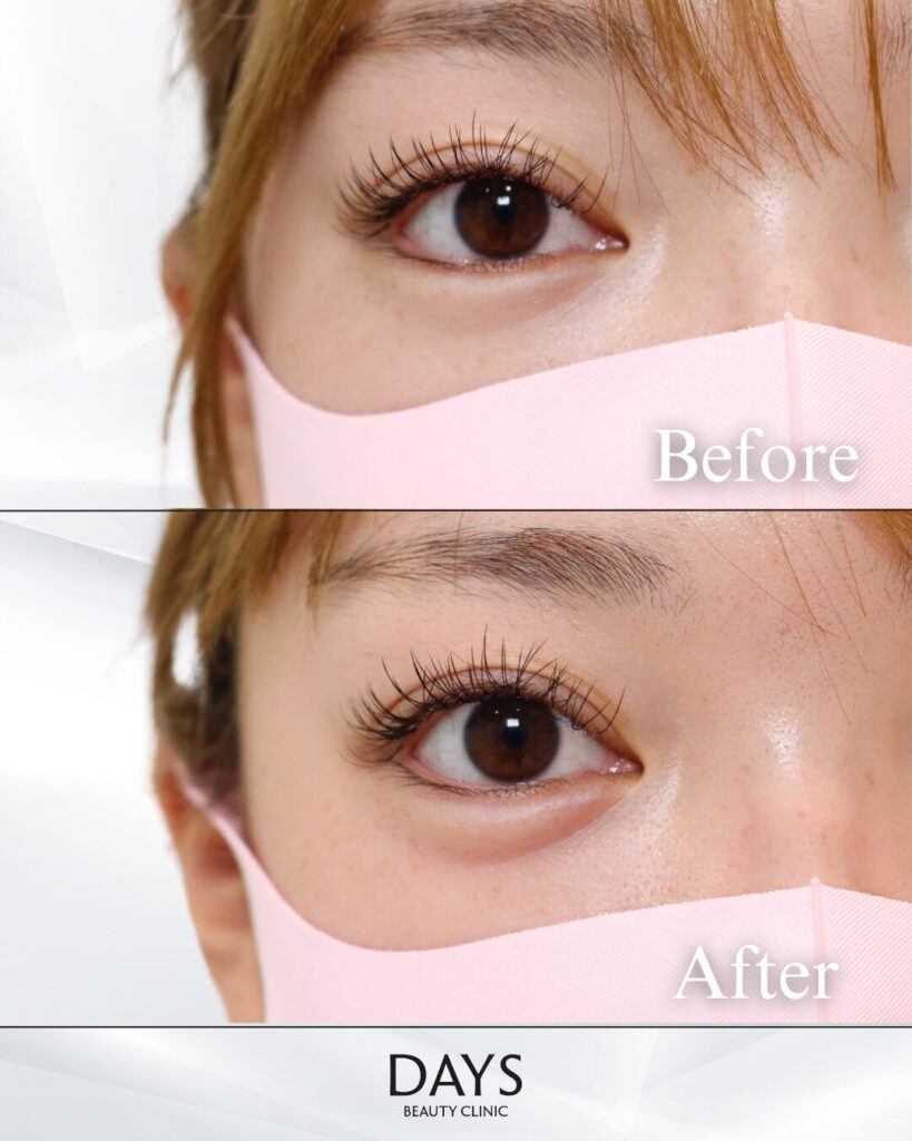 涙袋ヒアルロン酸　症例　20代女性