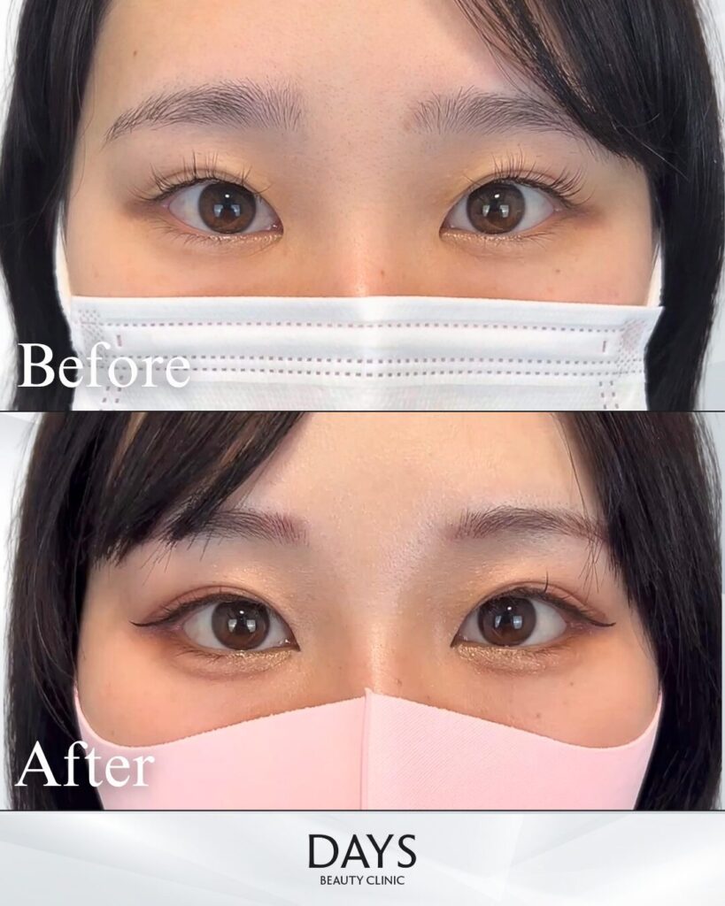 グラマラスライン形成　症例　20代女性