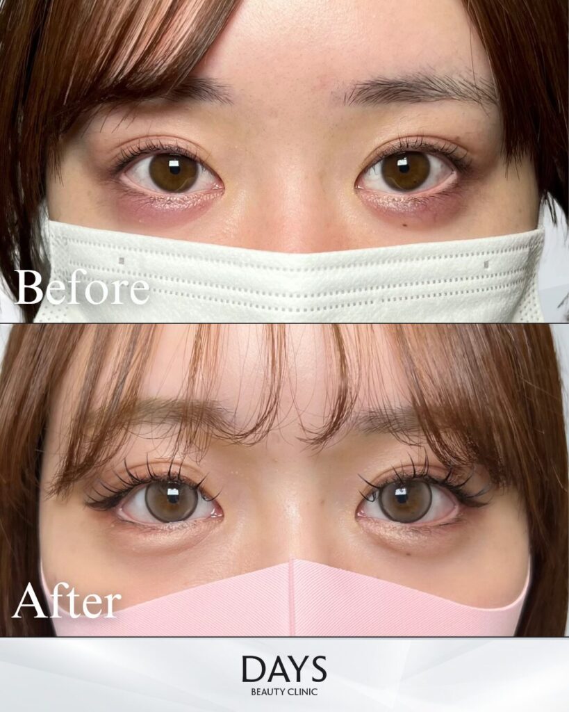 グラマラスライン形成　症例　20代女性