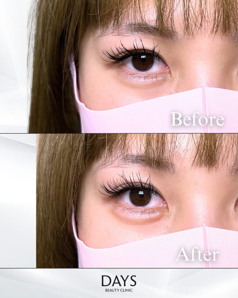 涙袋ヒアルロン酸　症例　20代女性