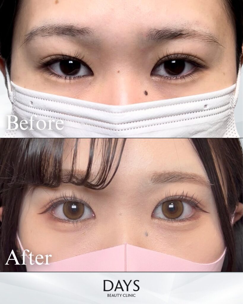 グラマラスライン形成　症例　20代女性