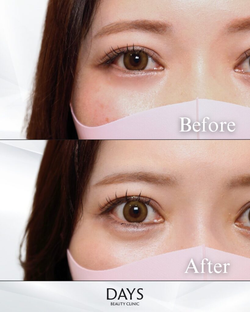 涙袋ヒアルロン酸　症例　20代女性