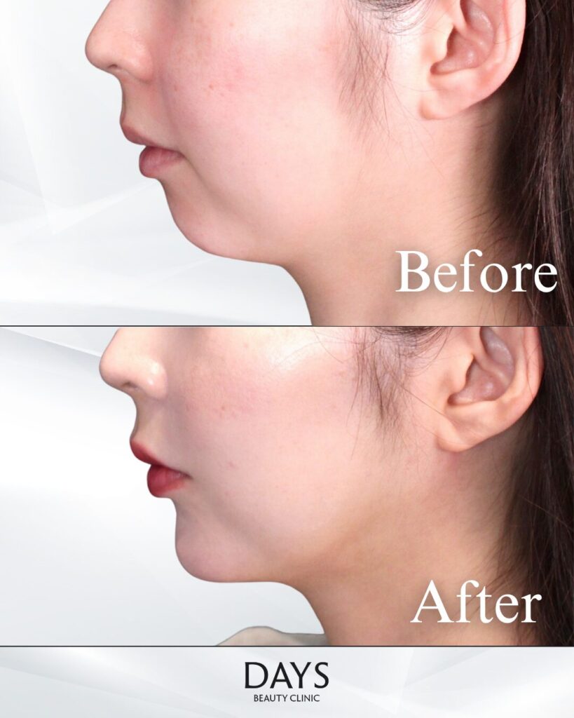 顎のヒアルロン酸　症例　20代女性