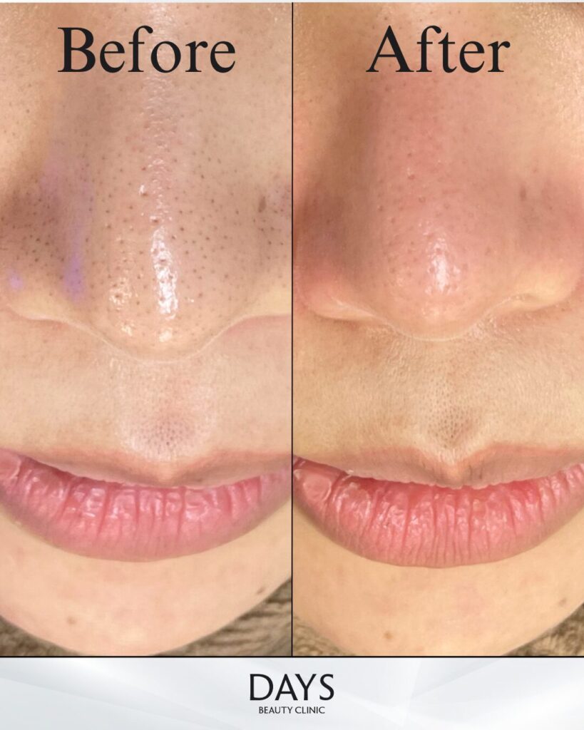 ハイドラジェントルの症例20代女性