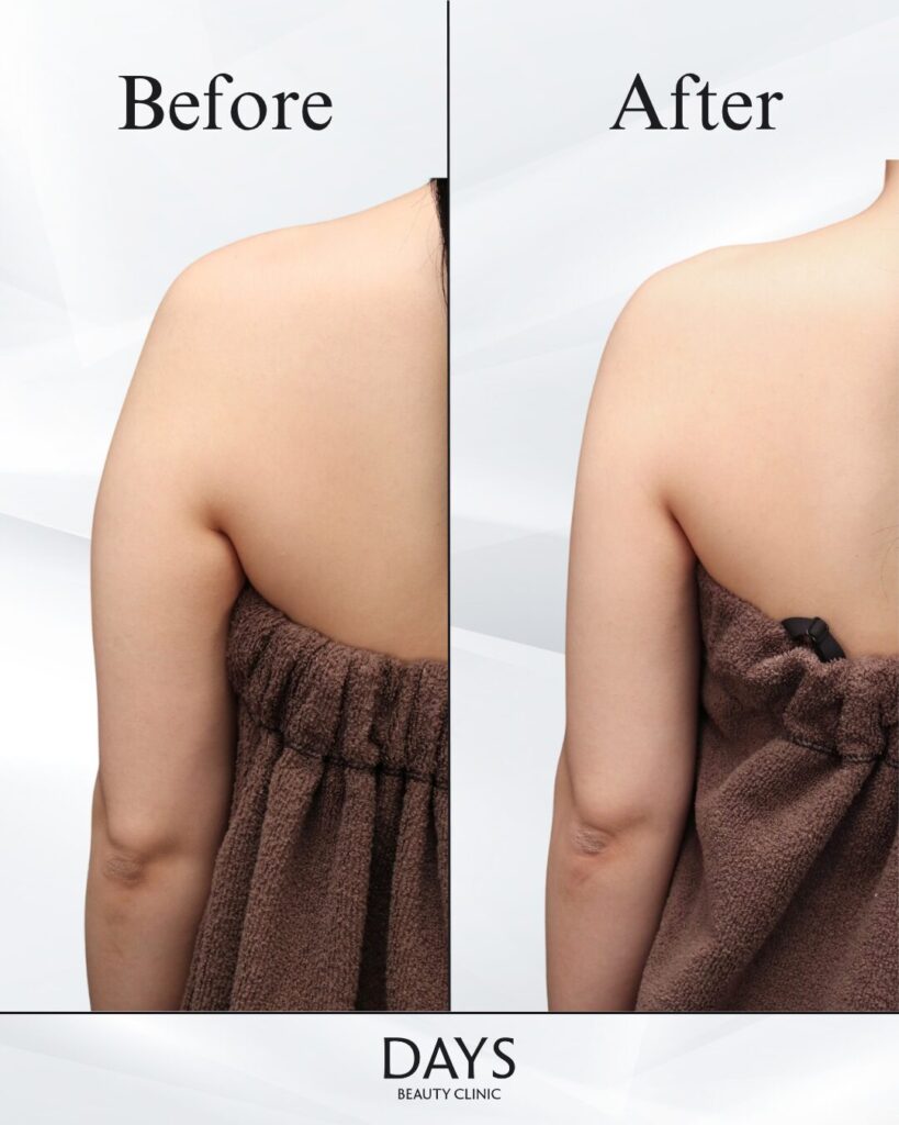 二の腕脂肪吸引　症例　20代女性