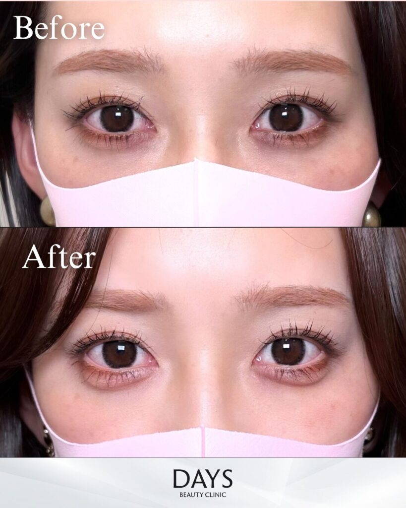 涙袋ヒアルロン酸　症例　20代女性