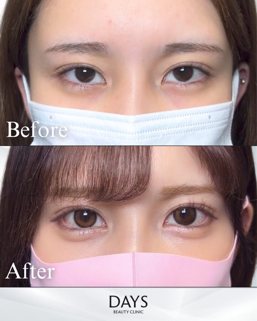 グラマラスライン形成　症例　20代女性