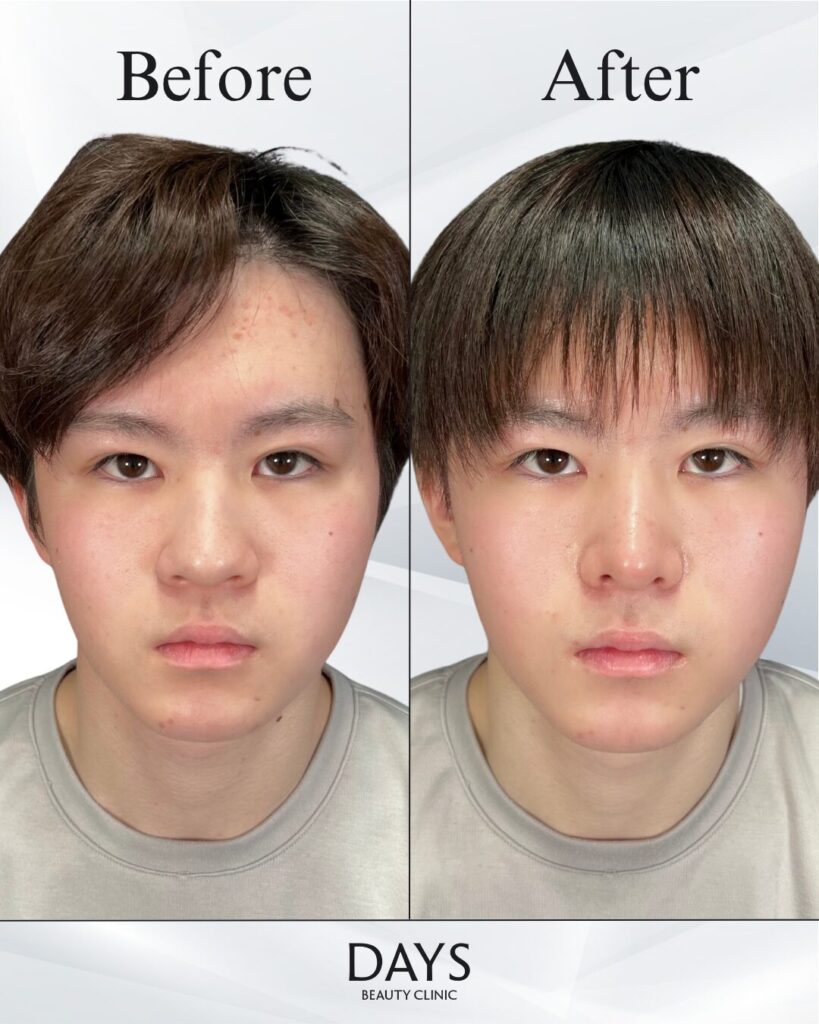 鼻施術　症例　20代男性