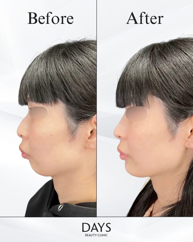 鼻施術　症例　30代女性