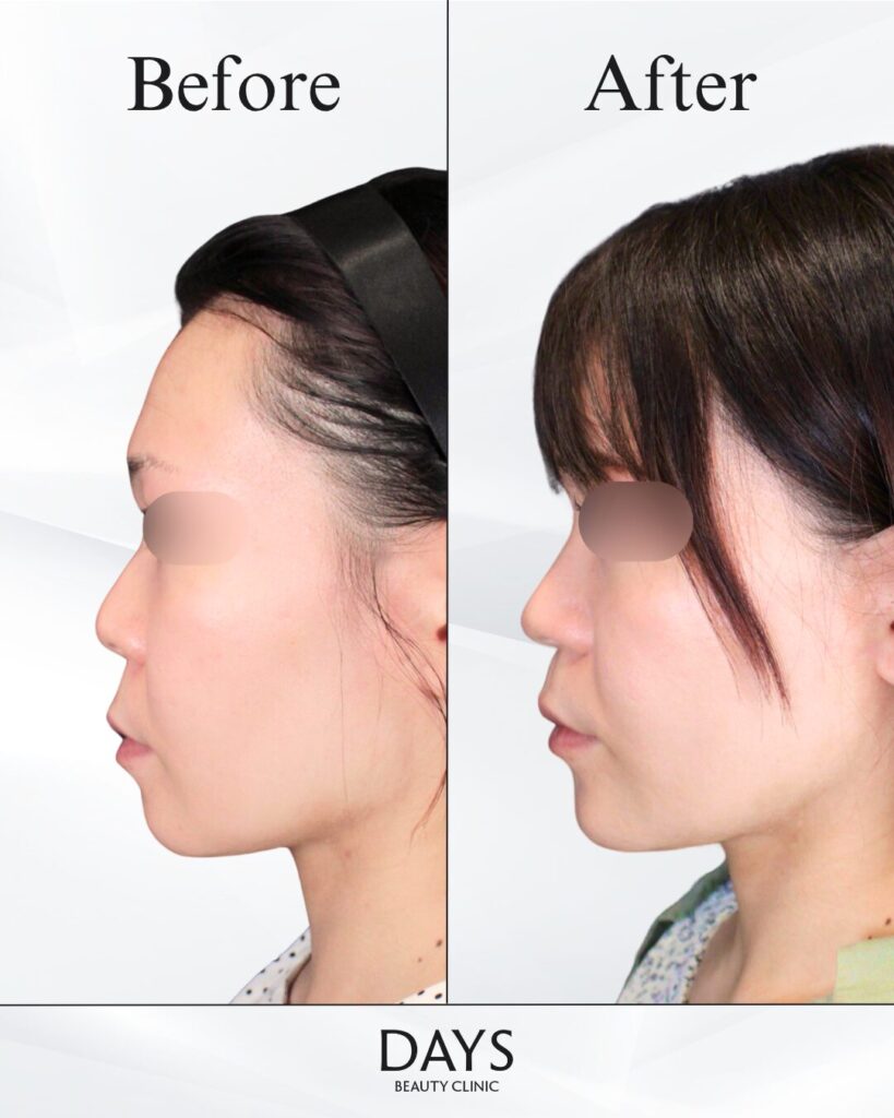 鼻施術　症例　20代女性