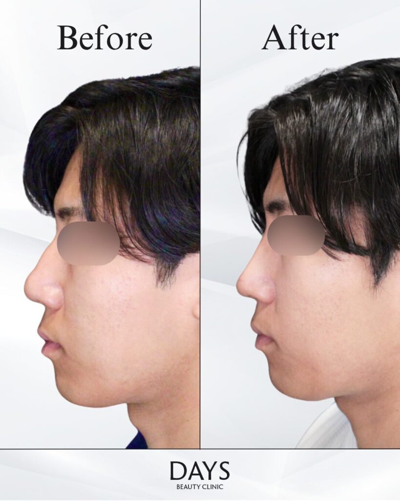 鼻施術　症例　20代男性