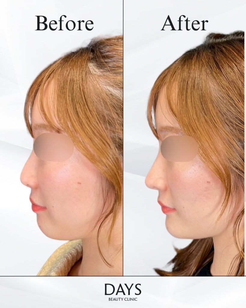 鼻施術　症例　20代女性