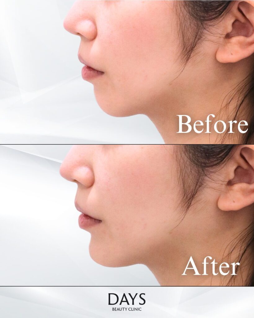 顎のヒアルロン酸　症例　20代女性