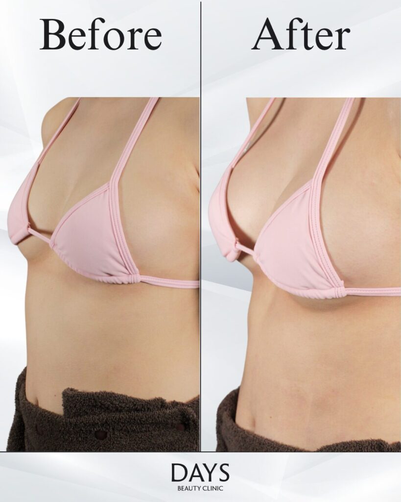 脂肪豊胸　症例　20代女性