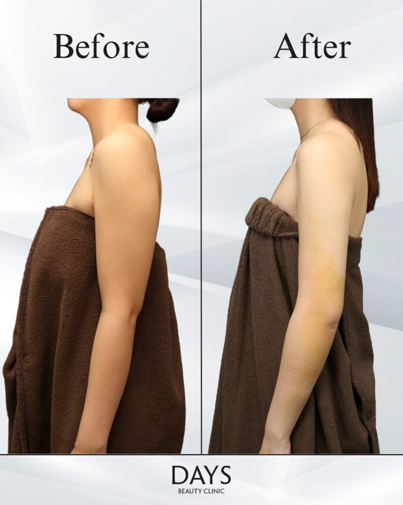 二の腕脂肪吸引　症例　20代女性