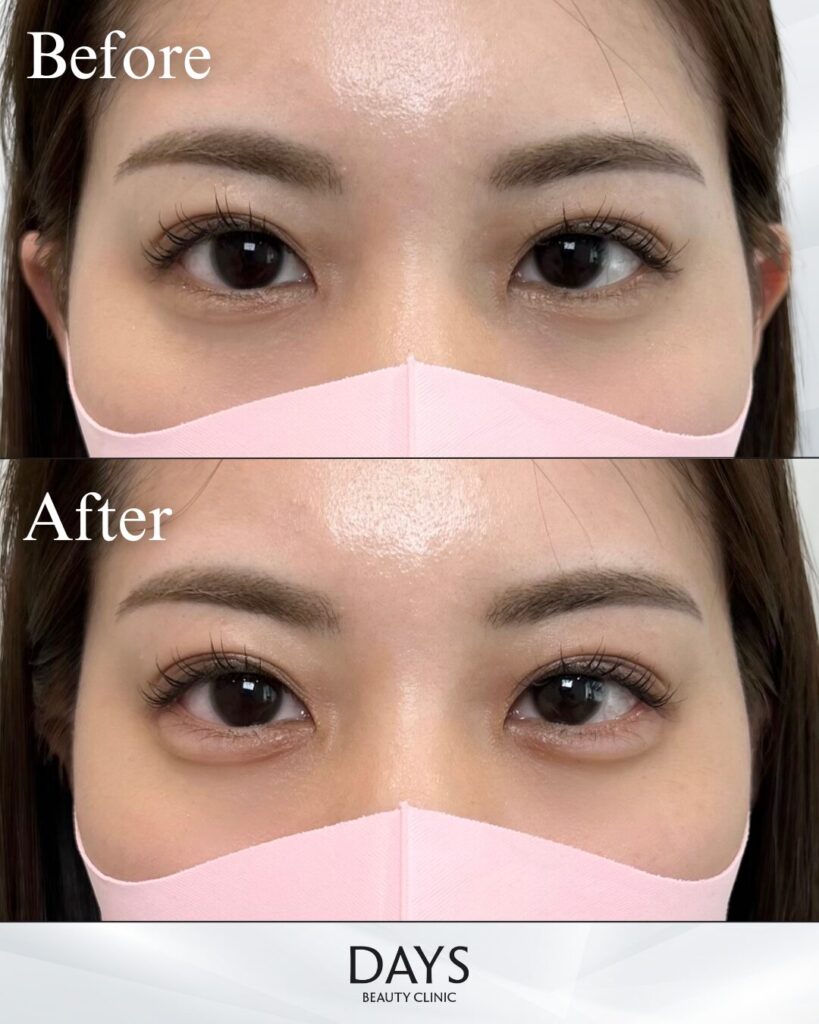 涙袋ヒアルロン酸　症例　20代女性