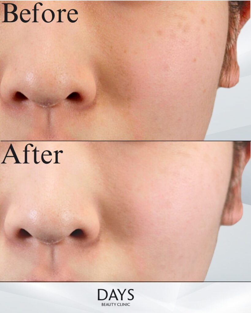 ディスカバリーピコ-ピコトーニング-の症例 20代女性