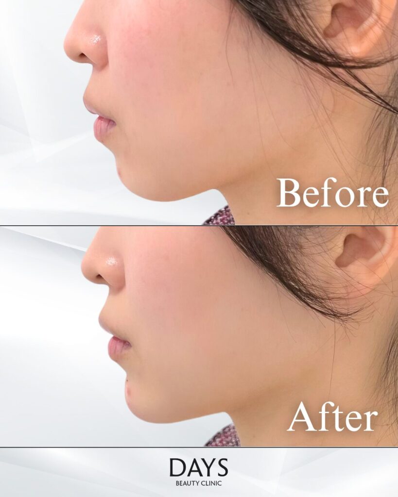 顎のヒアルロン酸　症例　30代女性