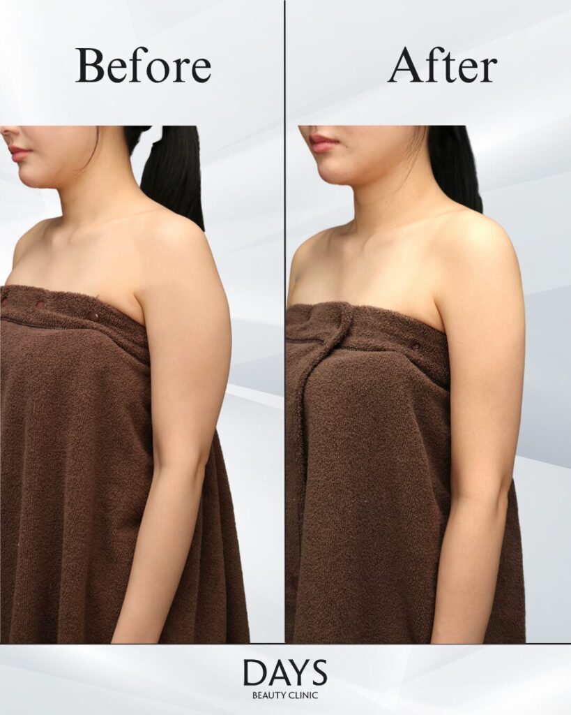 二の腕脂肪吸引　症例　20代女性