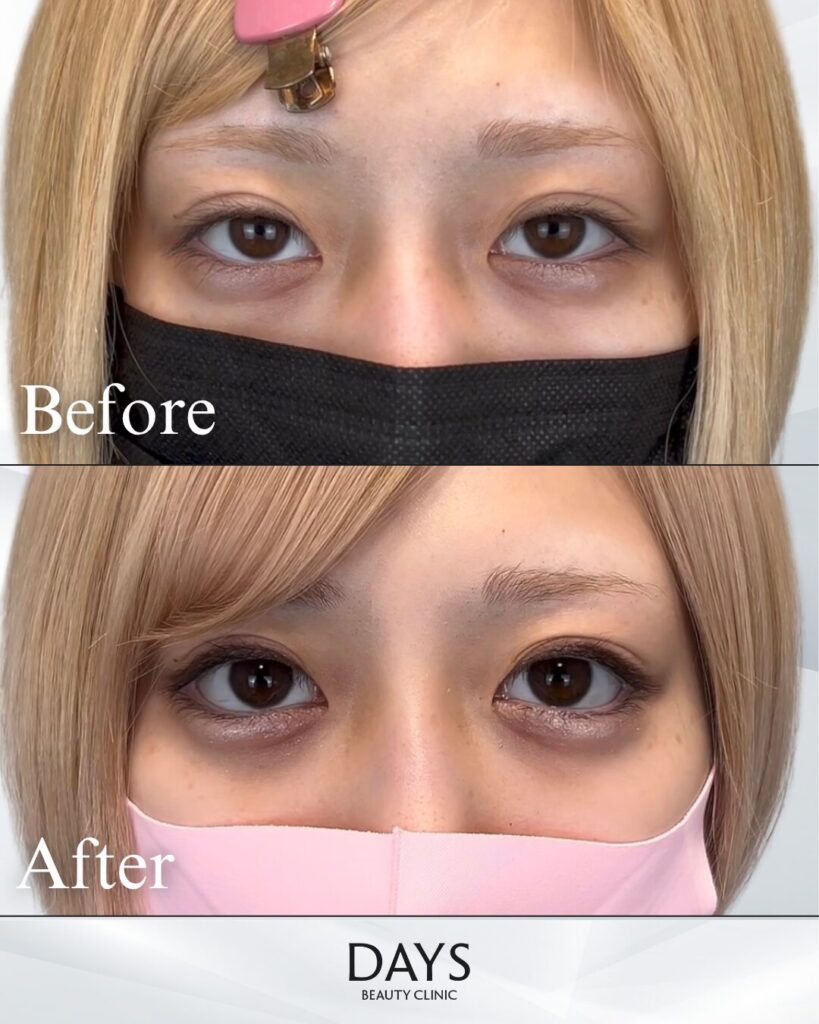 グラマラスライン形成　症例　20代女性