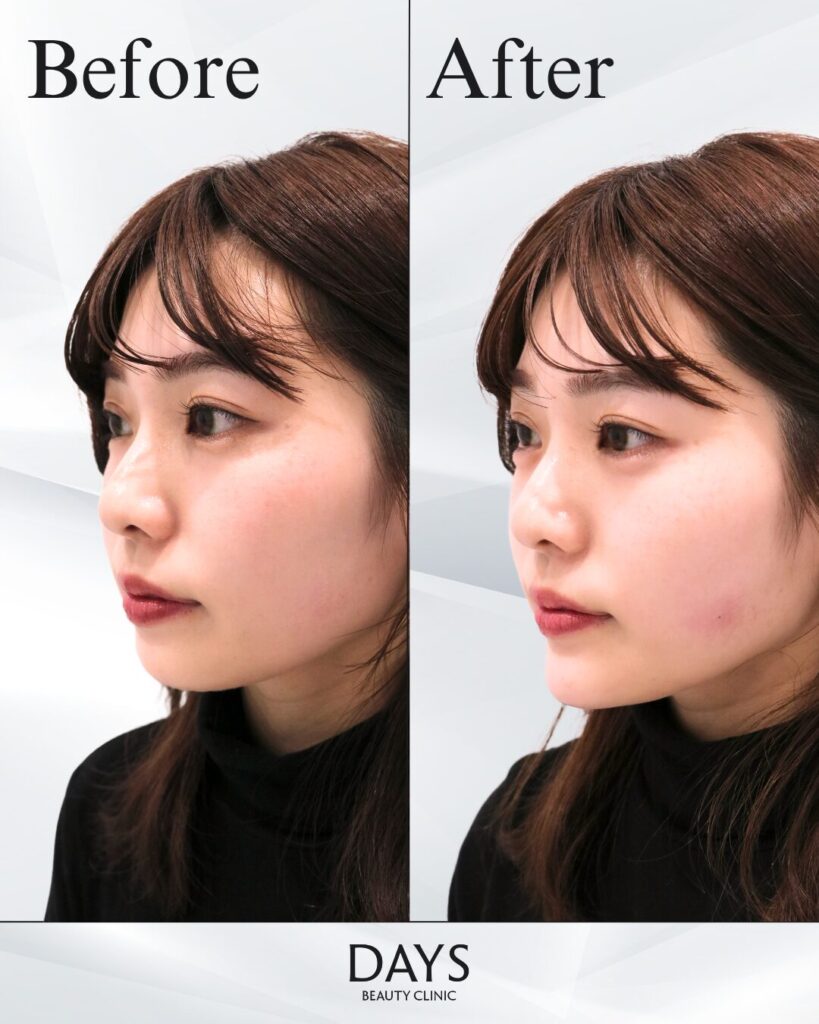 顎のヒアルロン酸　症例　20代女性