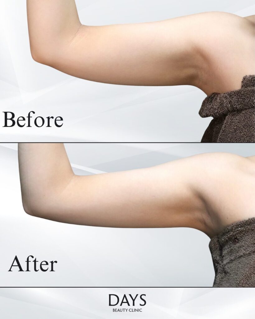 二の腕脂肪吸引　症例　20代女性