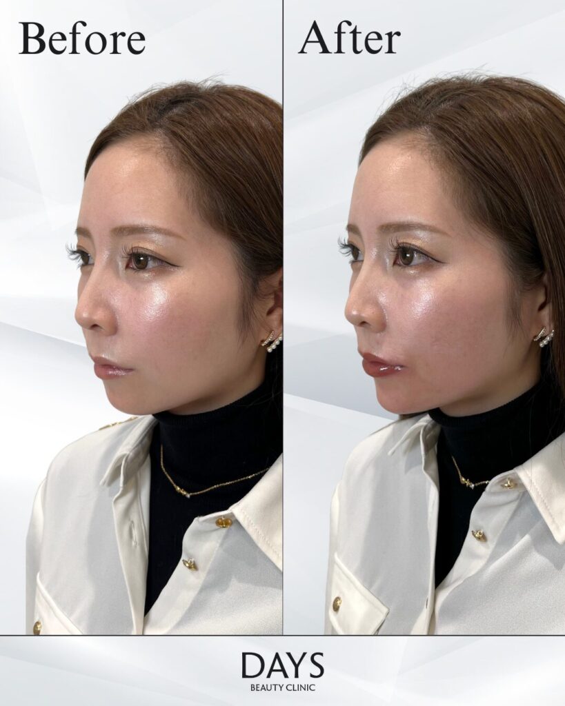 顎のヒアルロン酸　症例　30代女性